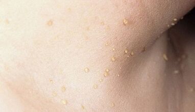 riscul de a dezvolta papilomatoză la nivelul gâtului