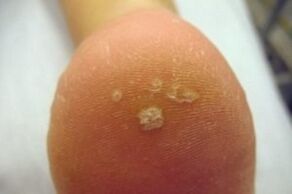 Negi plantar