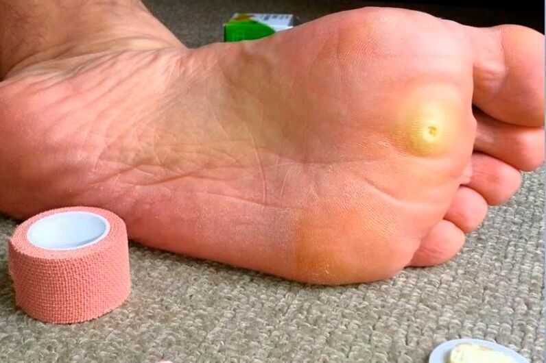 neg plantar pe picior