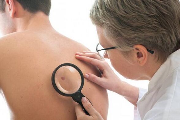 medicul examinează papilomul pe spate