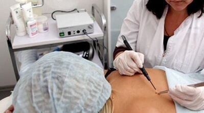 Electrocoagularea ca metodă de îndepărtare a negurilor